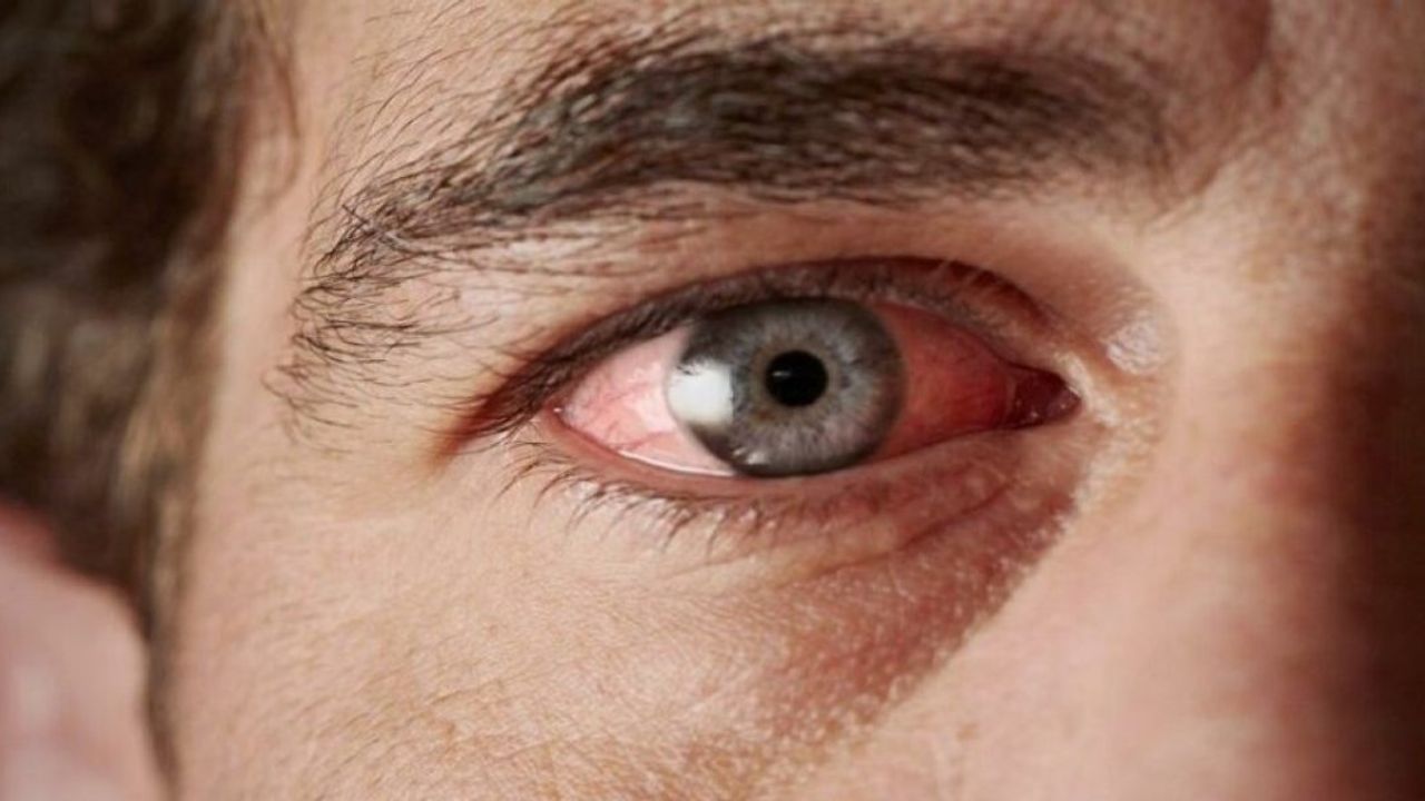 Hızla Yayılan Kırmızı Göz Hastalığı Okullarda Patlak Veriyor