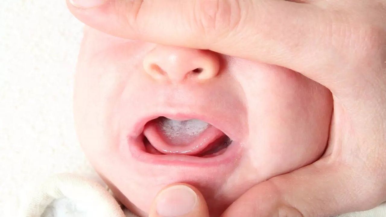 Bebeklerde Pamukçuk Enfeksiyonu Bağışıklık Sistemi Yetersizliğine İşaret Edebilir