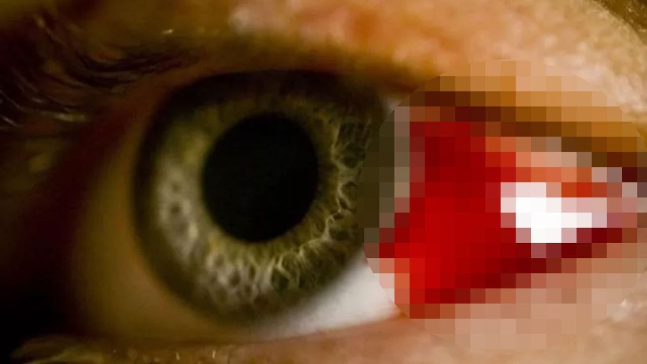 Fransa'da Göz Kanatan Virüs Tespit Edildi