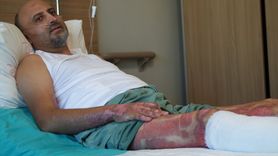 Mangal Jeli Kullanımında Dikkat: Bir İş Adamının Yanık Hikayesi