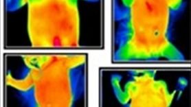 Yapay Zeka ile Prematüre Bebeklerde Hastalık Teşhisi