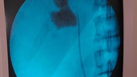 Kırşehir'de Kapalı Ameliyatla 6 Santimetrelik Taş Çıkarıldı