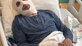 Sprey Boya Tüpünün Patlaması: Genç Adam Alevler İçinde Kaldı