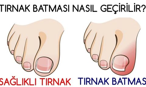 Tırnak Batması: Nedenleri, Tedavisi ve Evde Uygulanabilecek Yöntemler