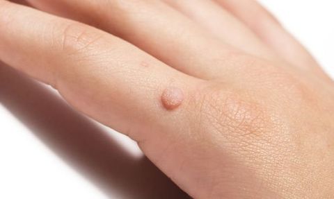 Vücuttaki Siğilleri Doğal Yöntemlerle Geçirme